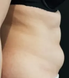 HS Abdomen Liposuction 2 Before Side