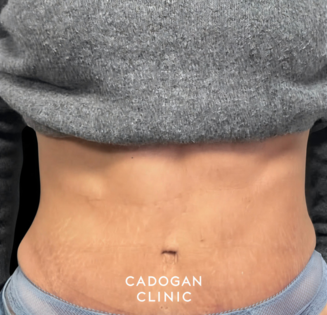Cadogan Clinic PT Abdo After