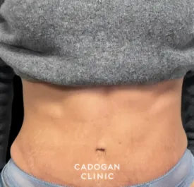 Cadogan Clinic PT Abdo After