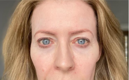 EH After Upper Blepharoplasty
