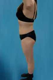OT Abdomen Liposuction After 1 Side