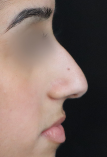 TJ Before Septorhinoplasty