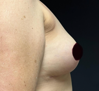 GG After Mastopexy Side
