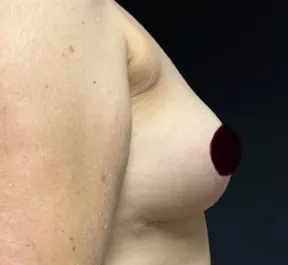 GG After Mastopexy Side