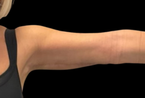 Cadogan Clinic Arm Lift PT After