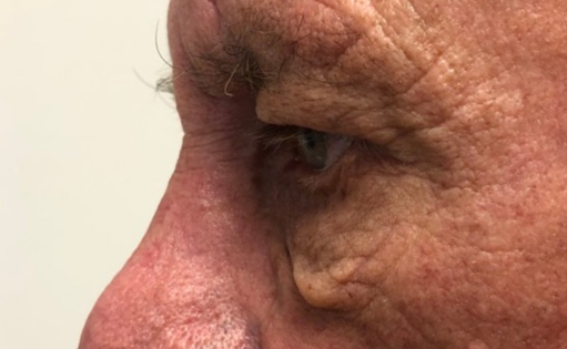 GG Before Male Lower Blepharoplasty