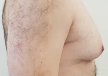 HS Male Chest Liposuction 1 Before Side