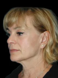 SC Before Face and Neck Lift
