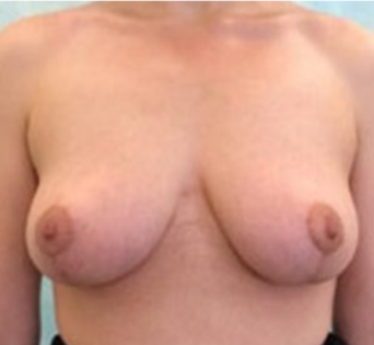 GG After Mastopexy