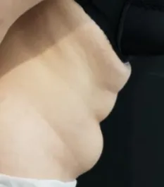 HS Abdomen Liposuction 2 Before Side Bent