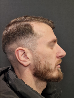 AN Rhinoplasty Before