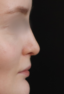 TJ After Septorhinoplasty