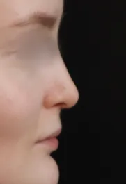 TJ After Septorhinoplasty