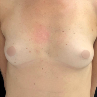 LDL Breast Augmentation Before