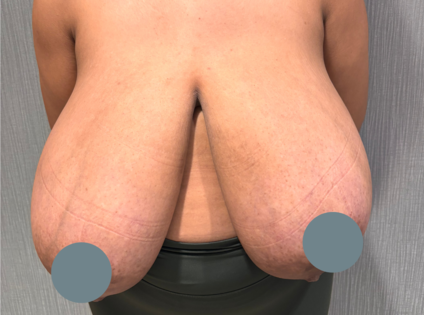SSJ Breast Reduction Before