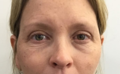 Unknown After Upper Blepharoplasty Front