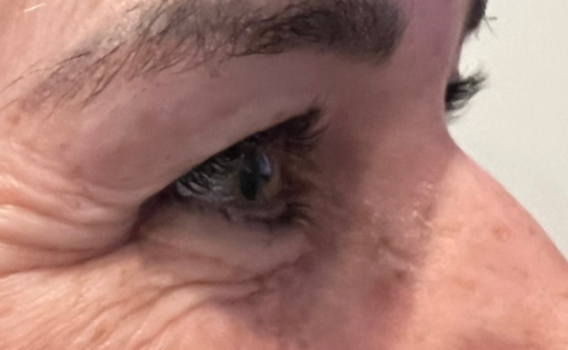 GG Before Upper Blepharoplasty Three Quarters