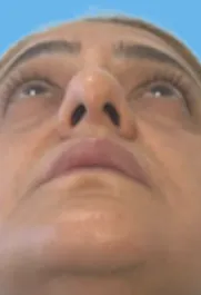 SP Septoplasty Before pt.3