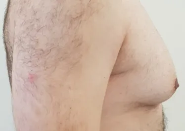 HS Male Chest Liposuction 1 After Side