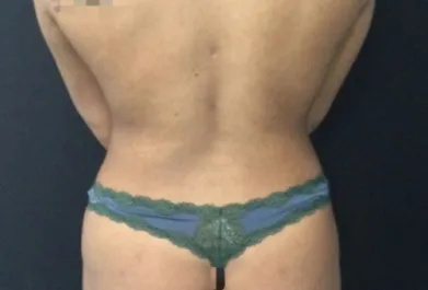 HS Flanks Liposuction After 1 Back