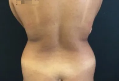 HS Flanks Liposuction Before 1 Back