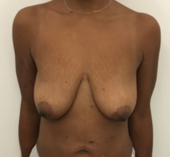Unknown Before Mastopexy