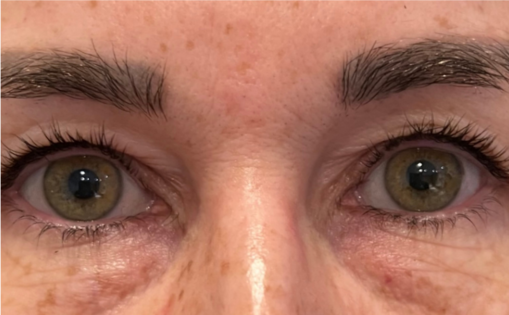 GG Before Upper Blepharoplasty Front