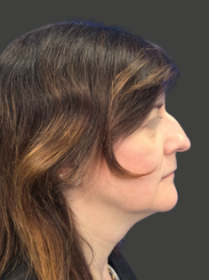AN Rhinoplasty Before