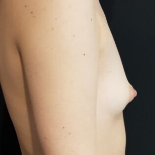 Cadogan Clinic HS FT Breast Before