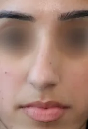 TJ Before Septorhinoplasty Front