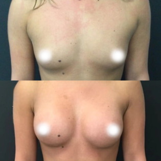 Ballerina Breast Augmentation Before and After
