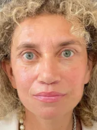 KY After Deep Plane Face and Neck Lift, Brow Lift