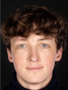 AN Rhinoplasty After