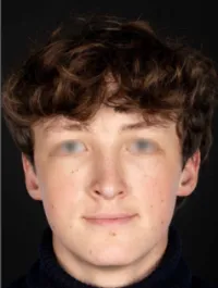 AN Rhinoplasty After