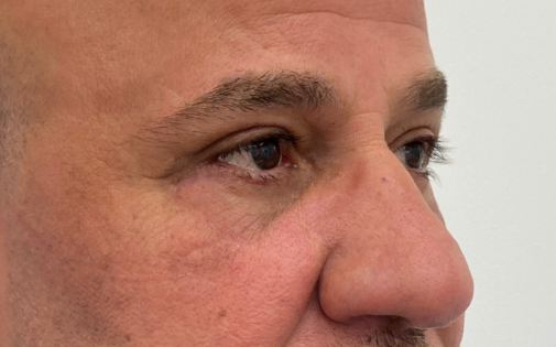 EH After Male Lower Blepharoplasty