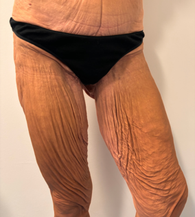 SSJ Thigh Lift Before