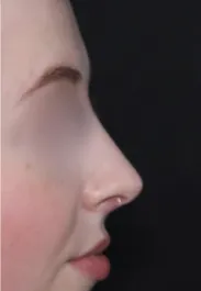 TJ Rhinoplasty After Side