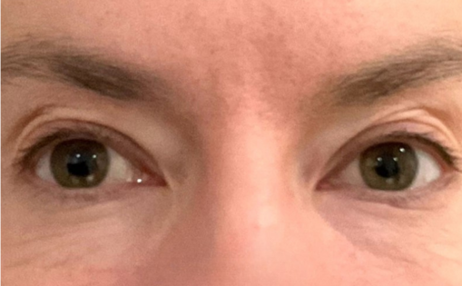 KY Before Upper Blepharoplasty Front