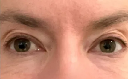 KY Before Upper Blepharoplasty Front