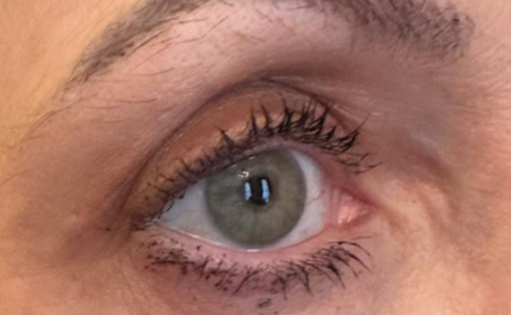 RR After Upper Blepharoplasty