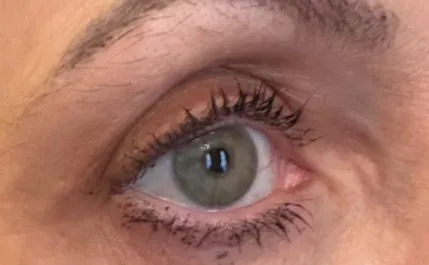 RR After Upper Blepharoplasty
