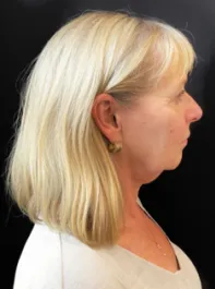 KY Before Face and Neck Lift with Fat Transfer