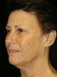SC Before Face and Neck Lift
