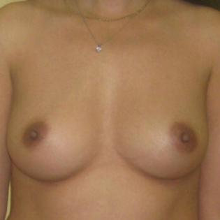 Fat Transfer Breast Before 3