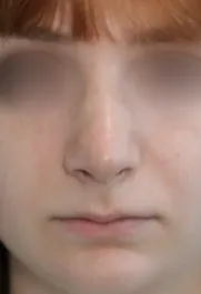TJ After Rhinoplasty Front