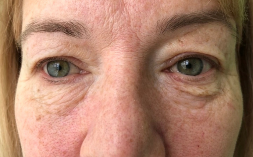 GG Before Upper and Lower Blepharoplasty