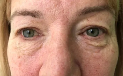 GG Before Upper and Lower Blepharoplasty