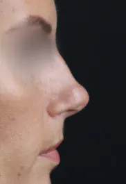 TJ Before Rhinoplasty Profile