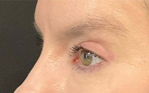 KY After Upper Blepharoplasty Three Quarters