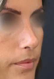 TJ After Rhinoplasty Three Quarter View